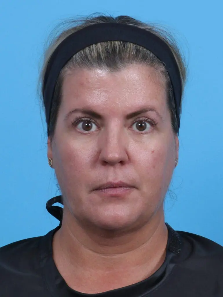 Eyelid Surgery - Case 28075 - After