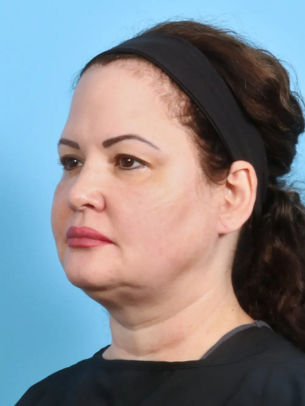 Brow Lift Patient Photo - Case 28079 - before view-1