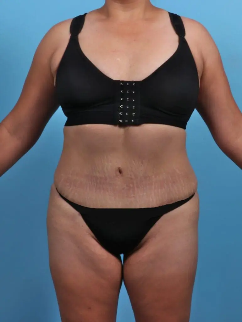 Tummy Tuck - Case 28095 - After