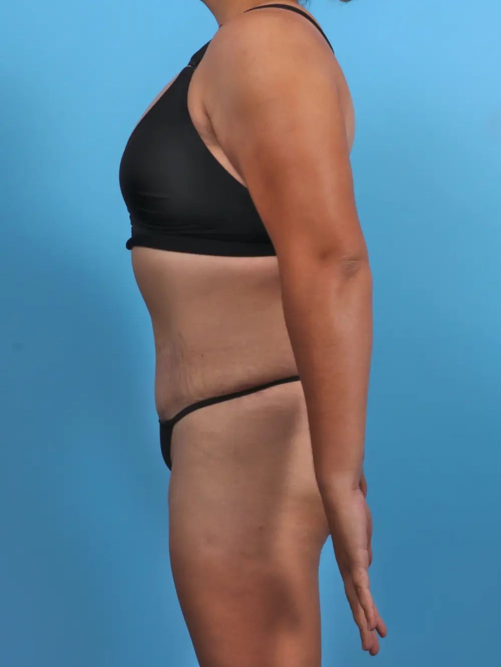 Tummy Tuck Patient Photo - Case 28095 - after view-2