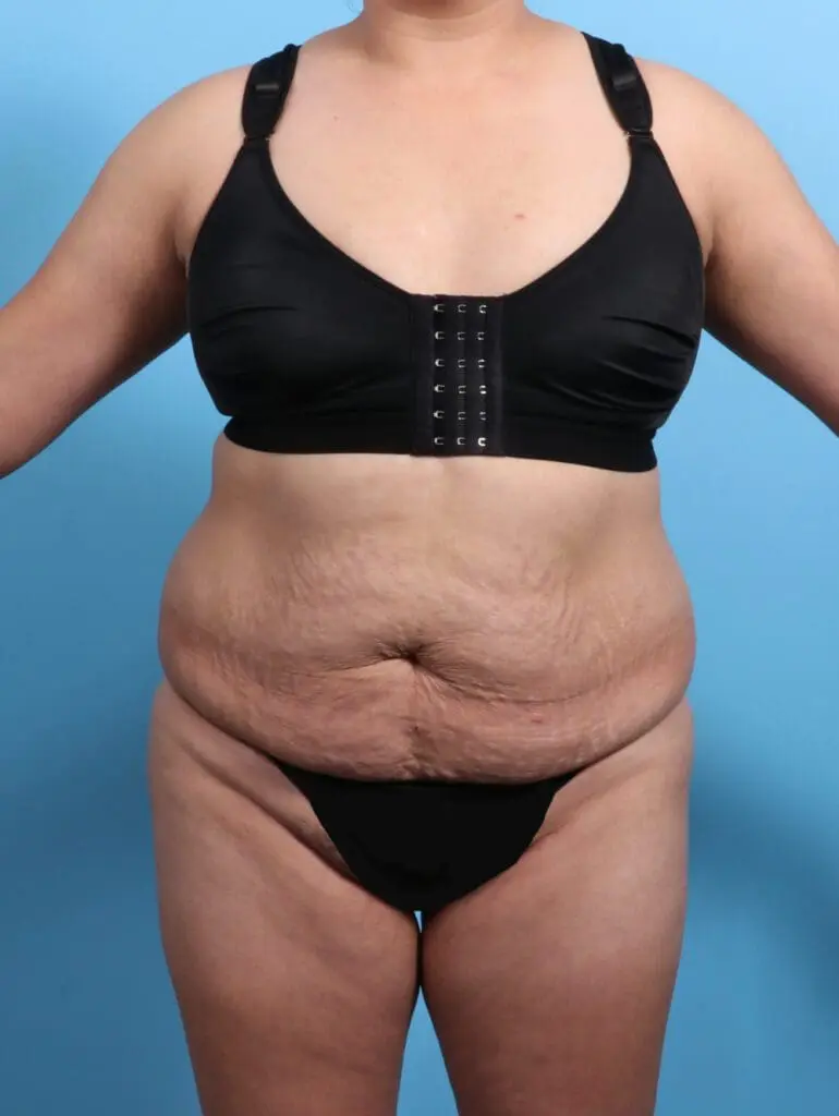 Tummy Tuck - Case 28095 - Before