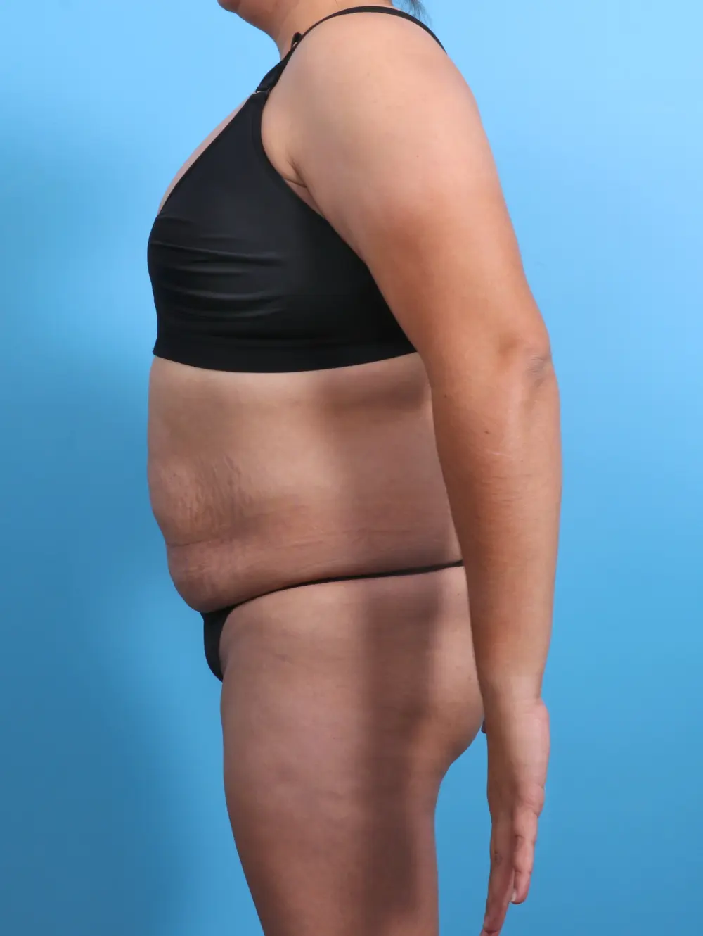 Tummy Tuck Patient Photo - Case 28095 - before view-2