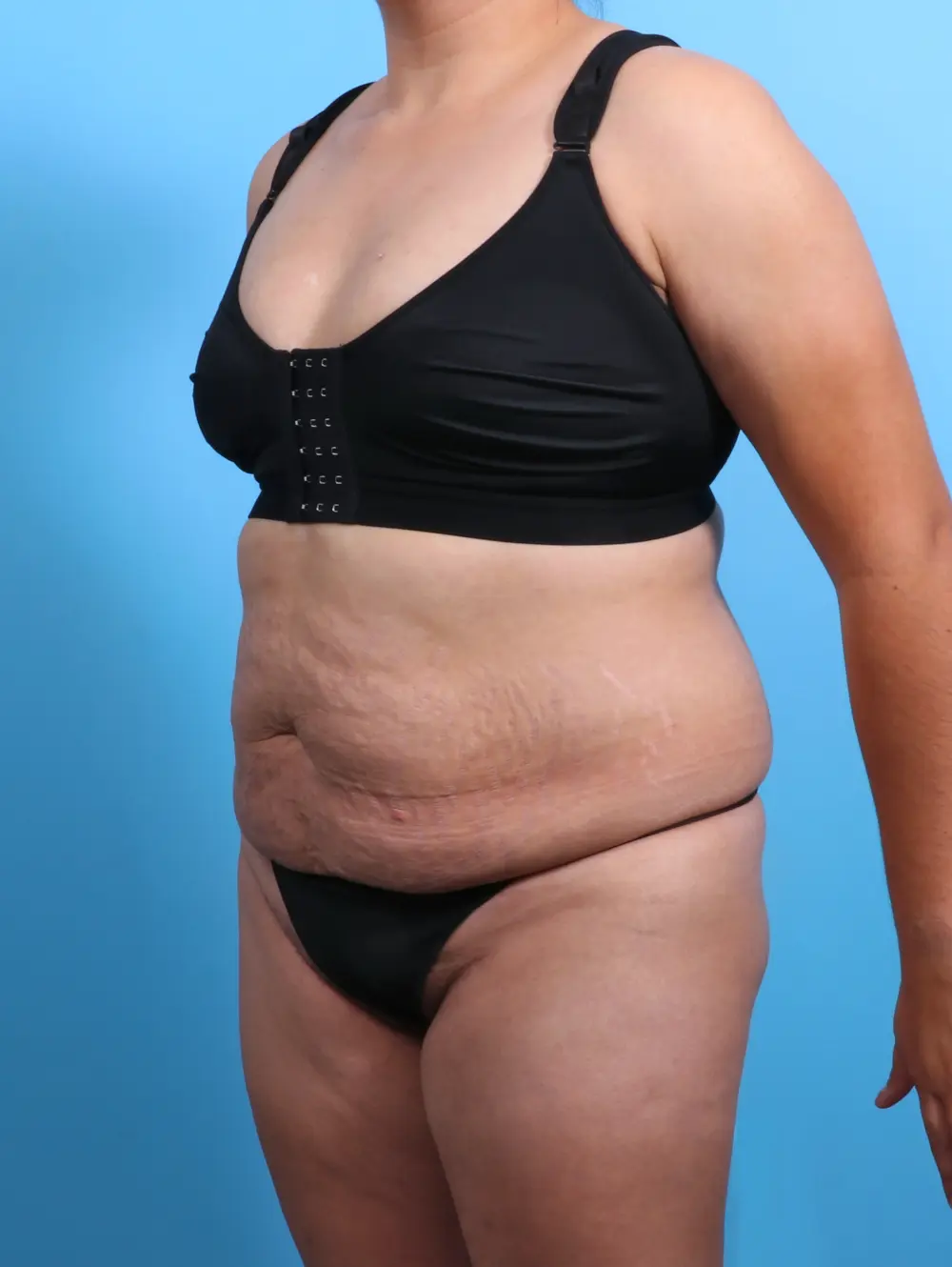 Tummy Tuck Patient Photo - Case 28095 - before view-1