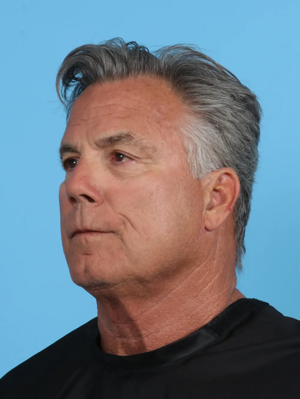 Eyelid Surgery Patient Photo - Case 28105 - before view-1