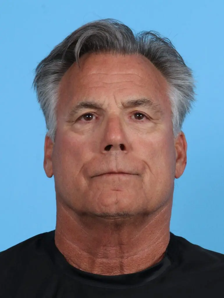 Eyelid Surgery - Case 28105 - Before