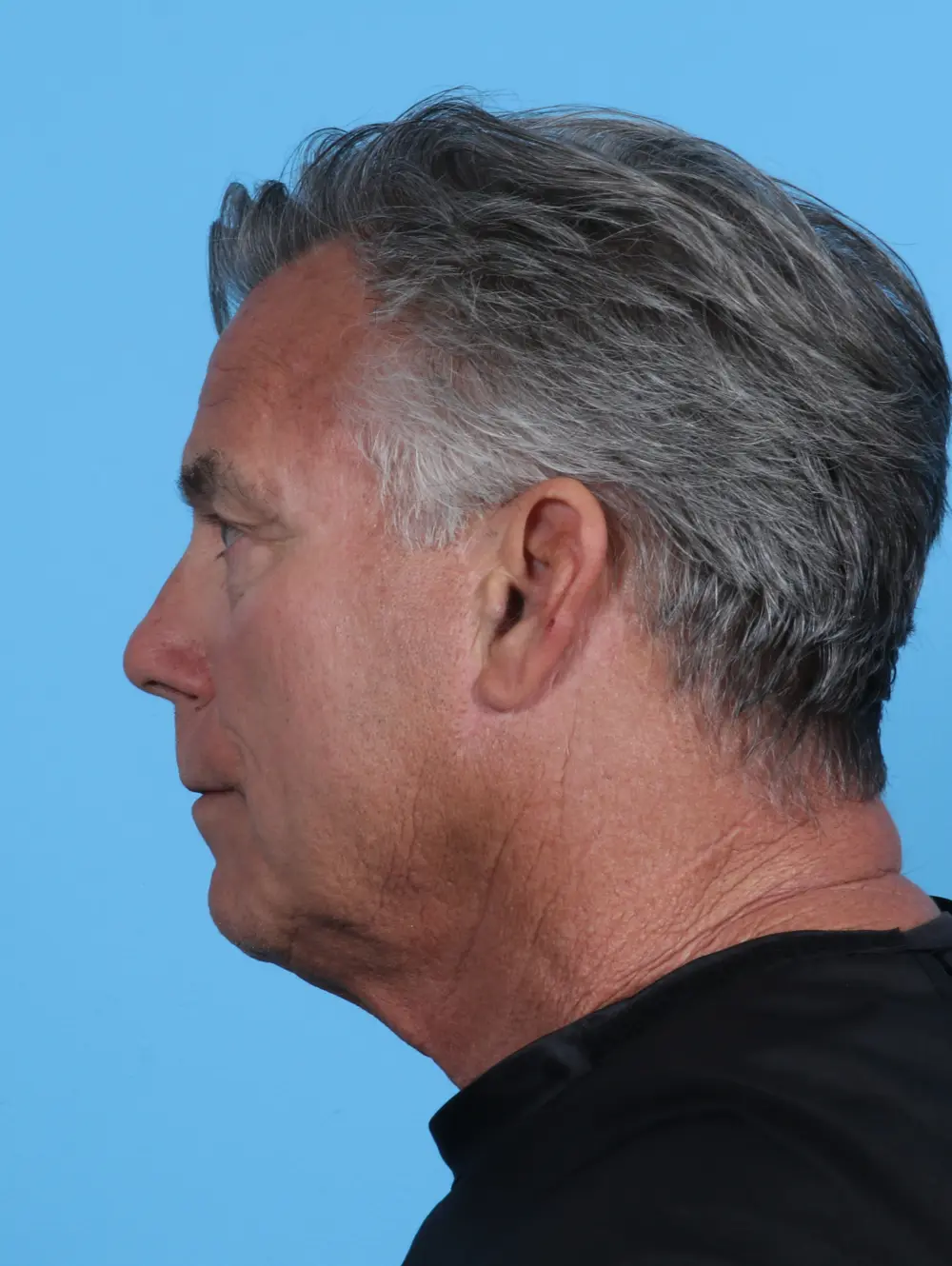 Eyelid Surgery Patient Photo - Case 28105 - before view-2