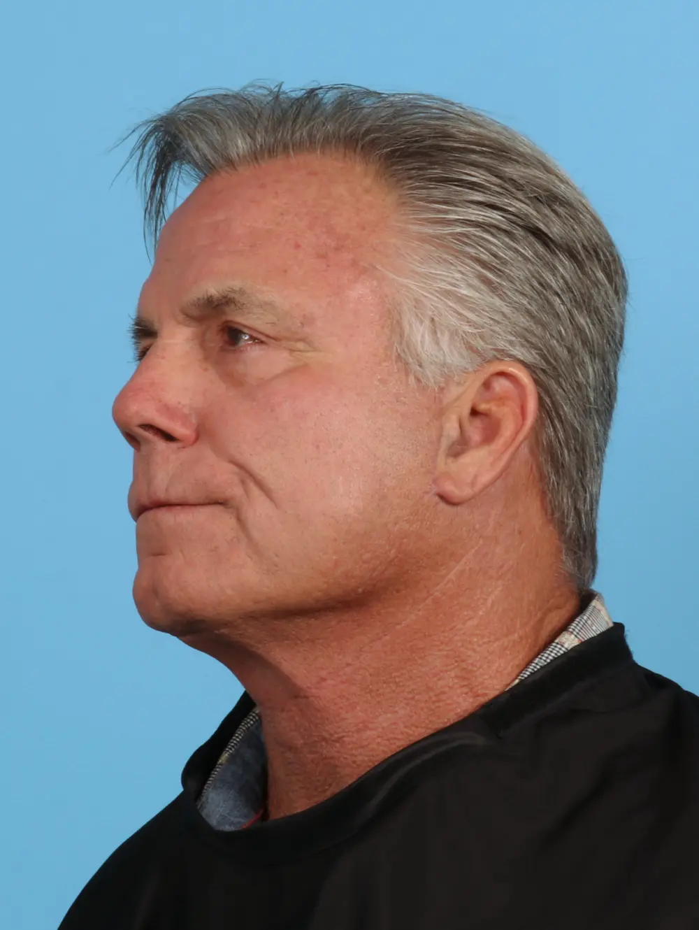 Eyelid Surgery Patient Photo - Case 28105 - after view-1