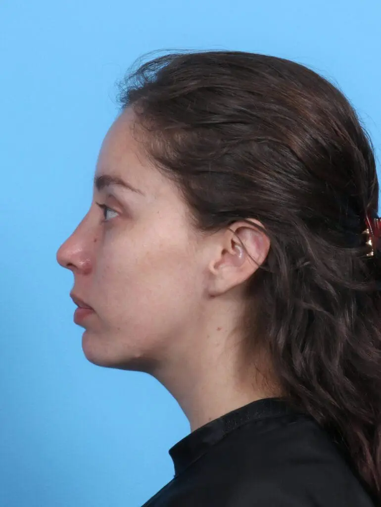 Chin Implant - Case 28121 - After