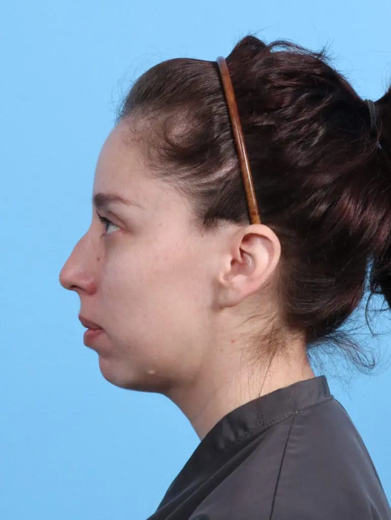 Chin Implant - Case 28121 - Before