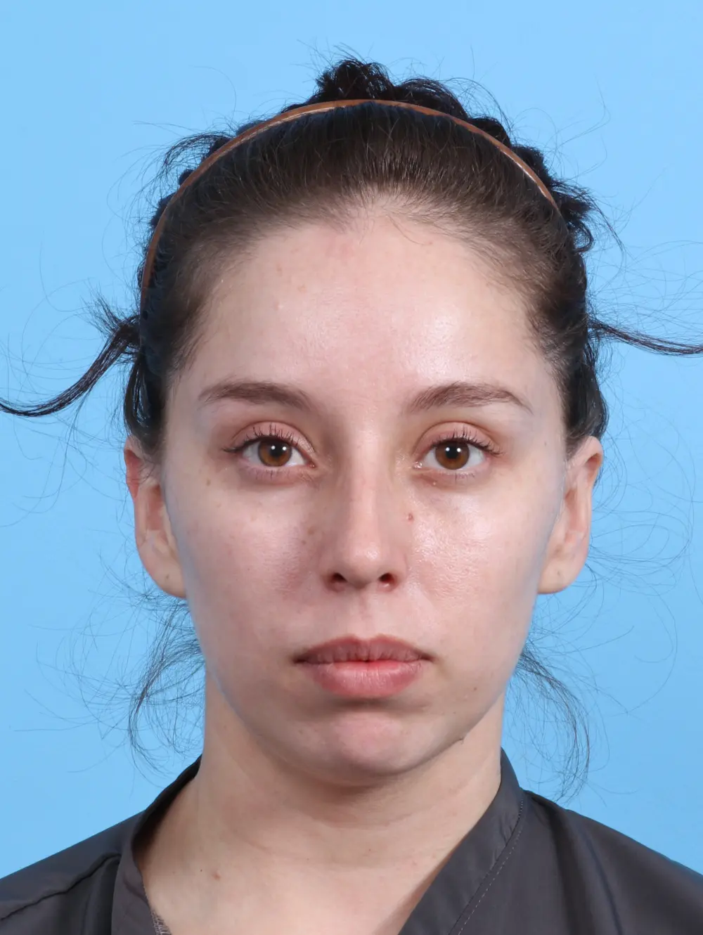 Chin Implant Patient Photo - Case 28121 - before view-2