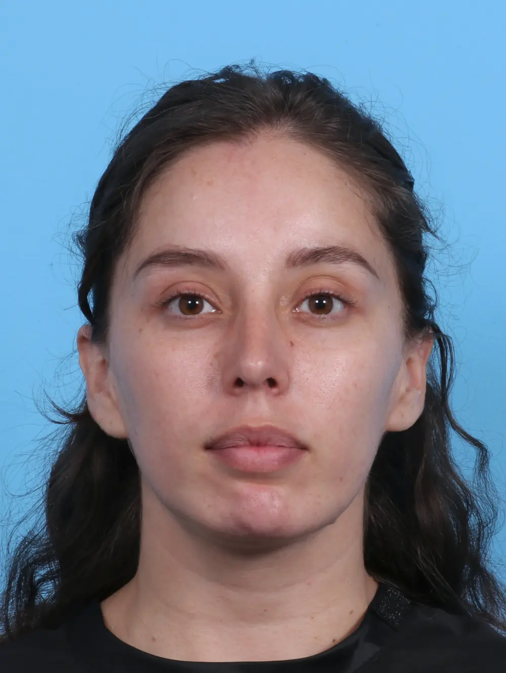 Chin Implant Patient Photo - Case 28121 - after view-2