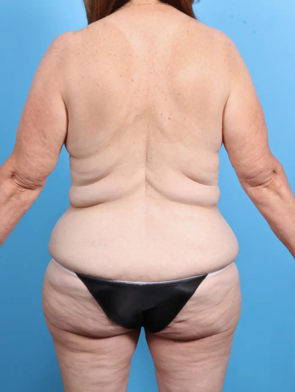 Body Lift Patient Photo - Case 28129 - before view-3