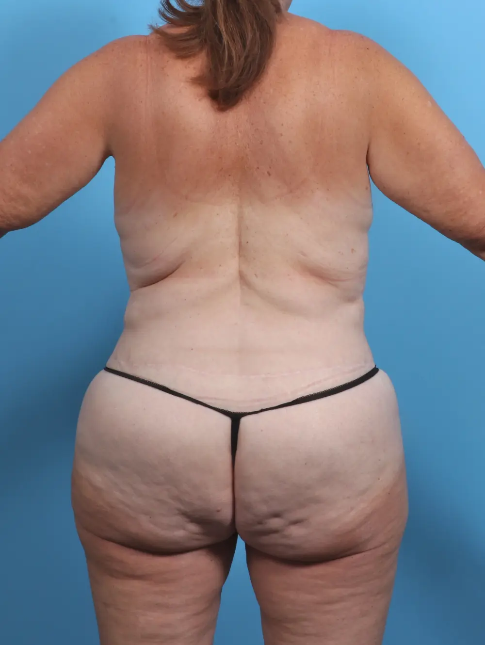 Body Lift Patient Photo - Case 28129 - after view-3