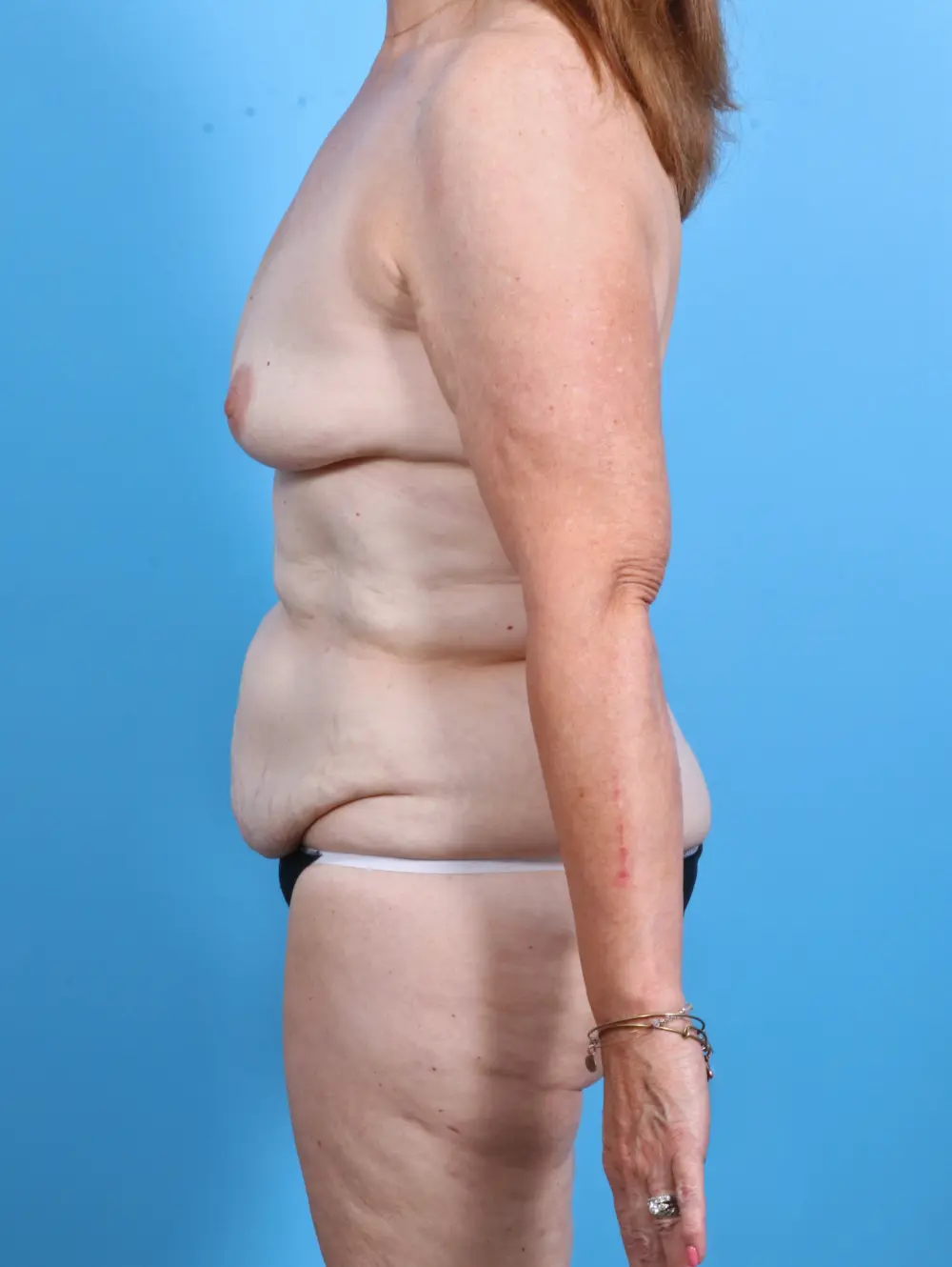 Body Lift Patient Photo - Case 28129 - before view-2