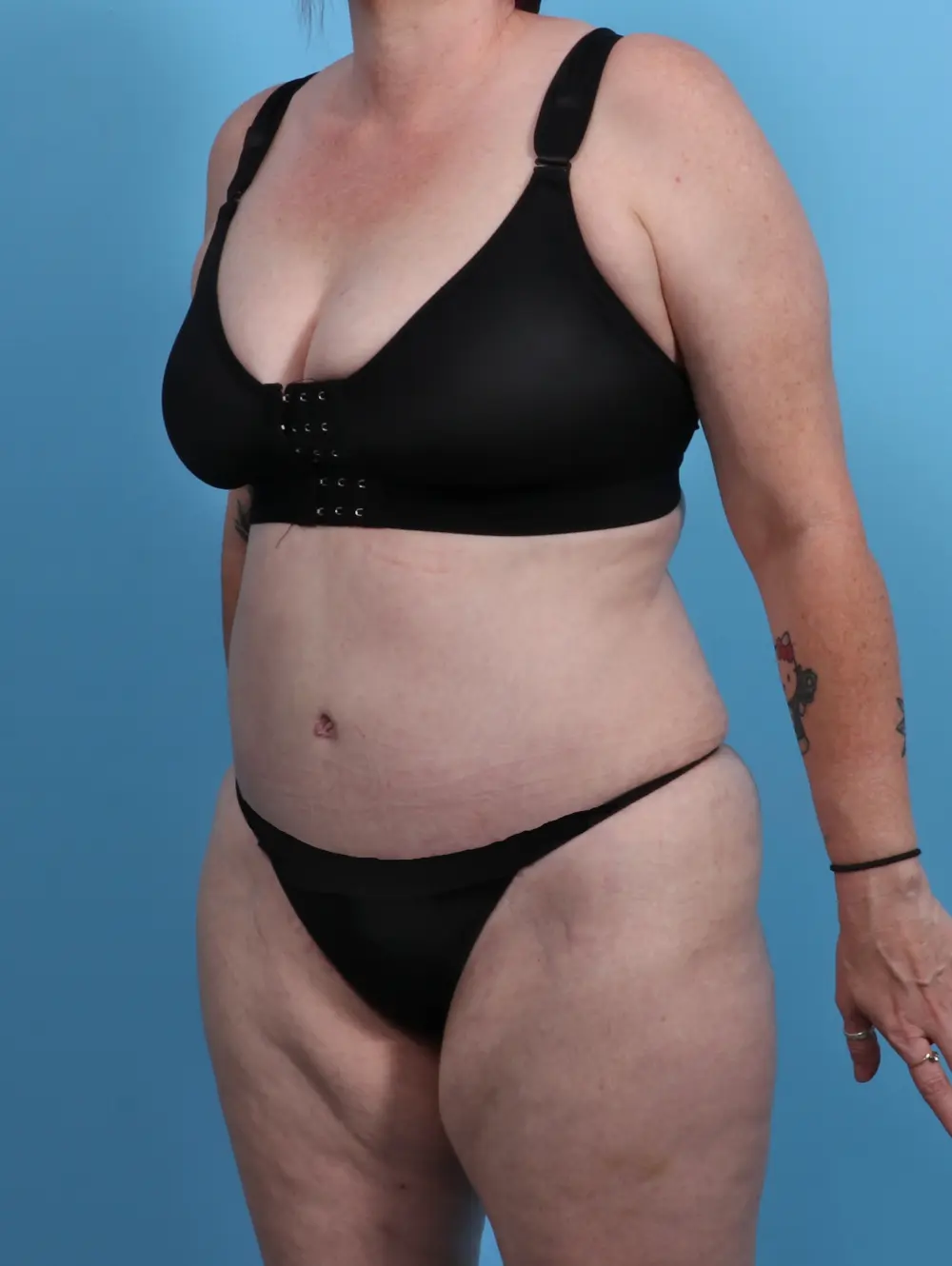 Tummy Tuck Patient Photo - Case 28139 - after view-1