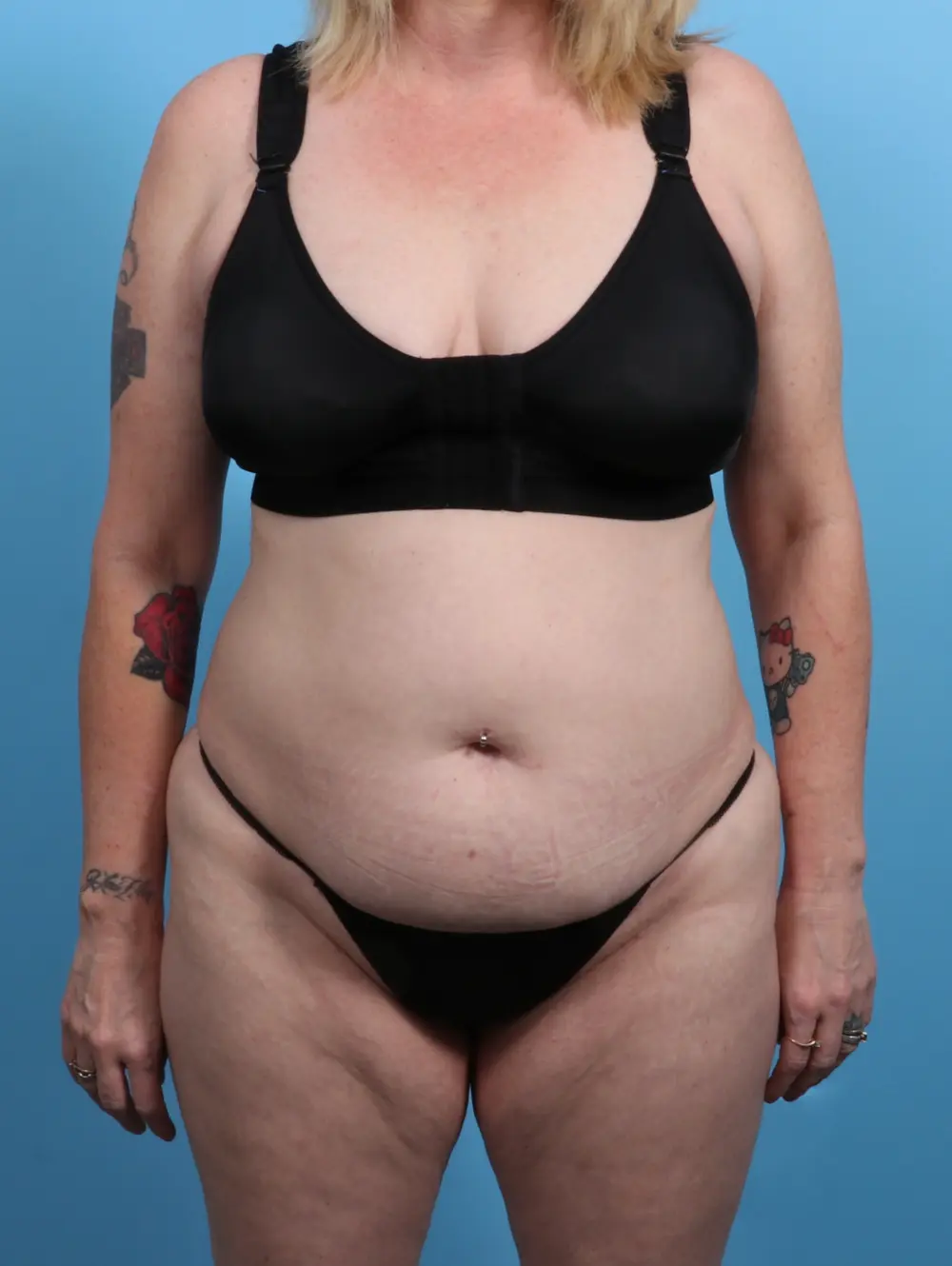 Tummy Tuck Patient Photo - Case 28139 - before view-