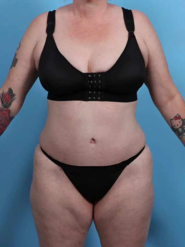 Tummy Tuck - Case 28139 - After