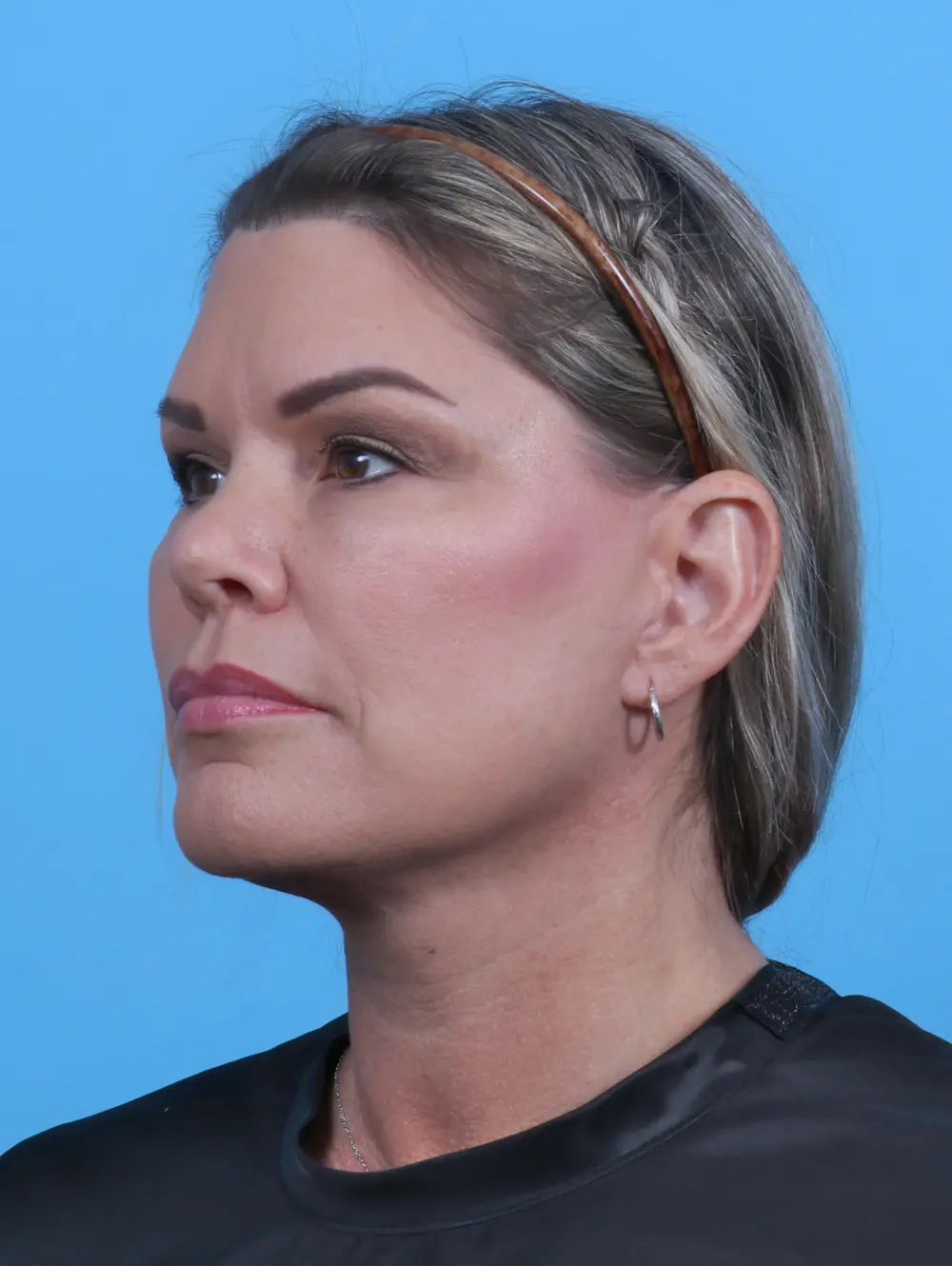 Facelift / Neck Lift Patient Photo - Case 28149 - after view-1