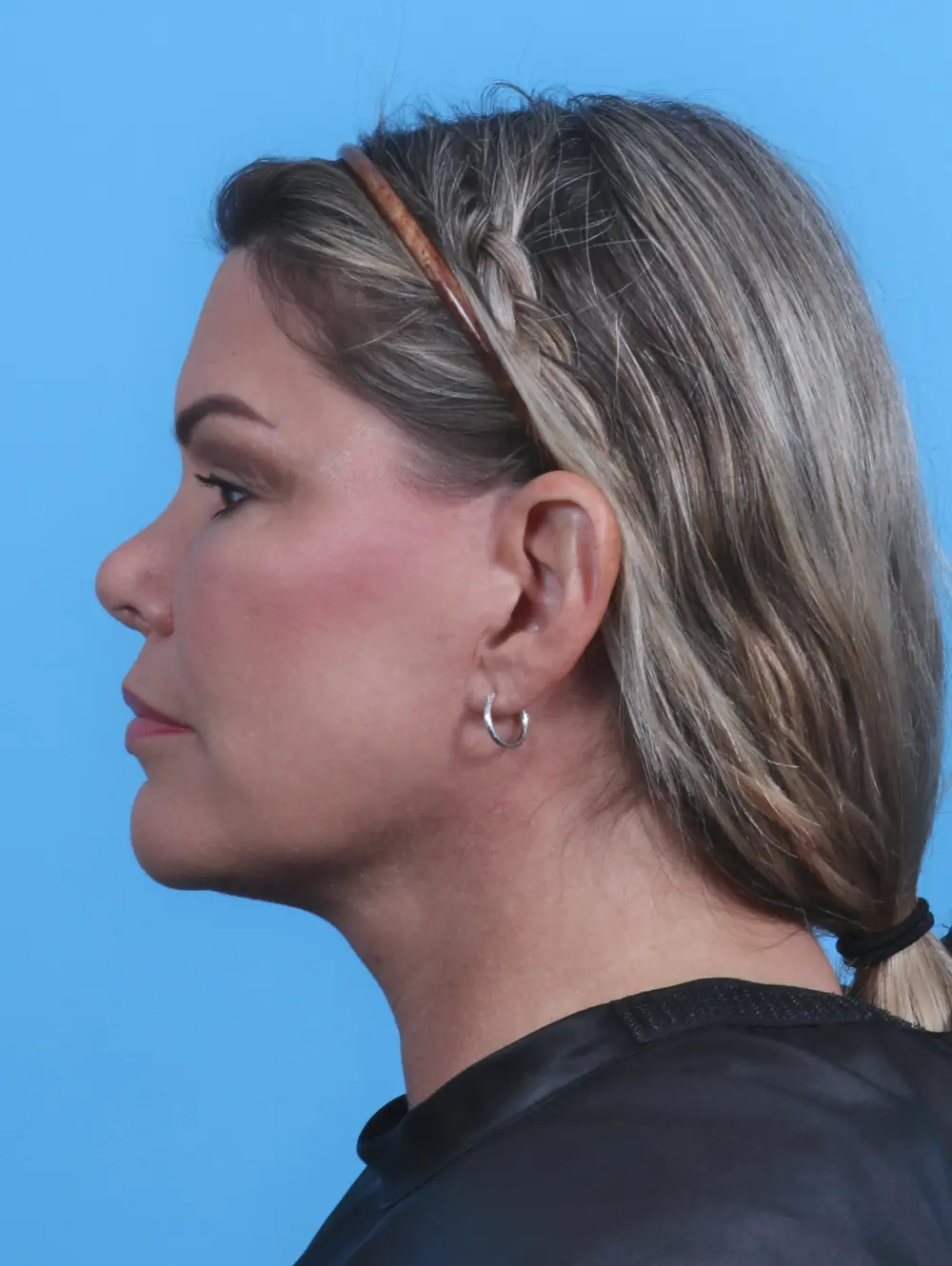 Facelift / Neck Lift Patient Photo - Case 28149 - after view-2