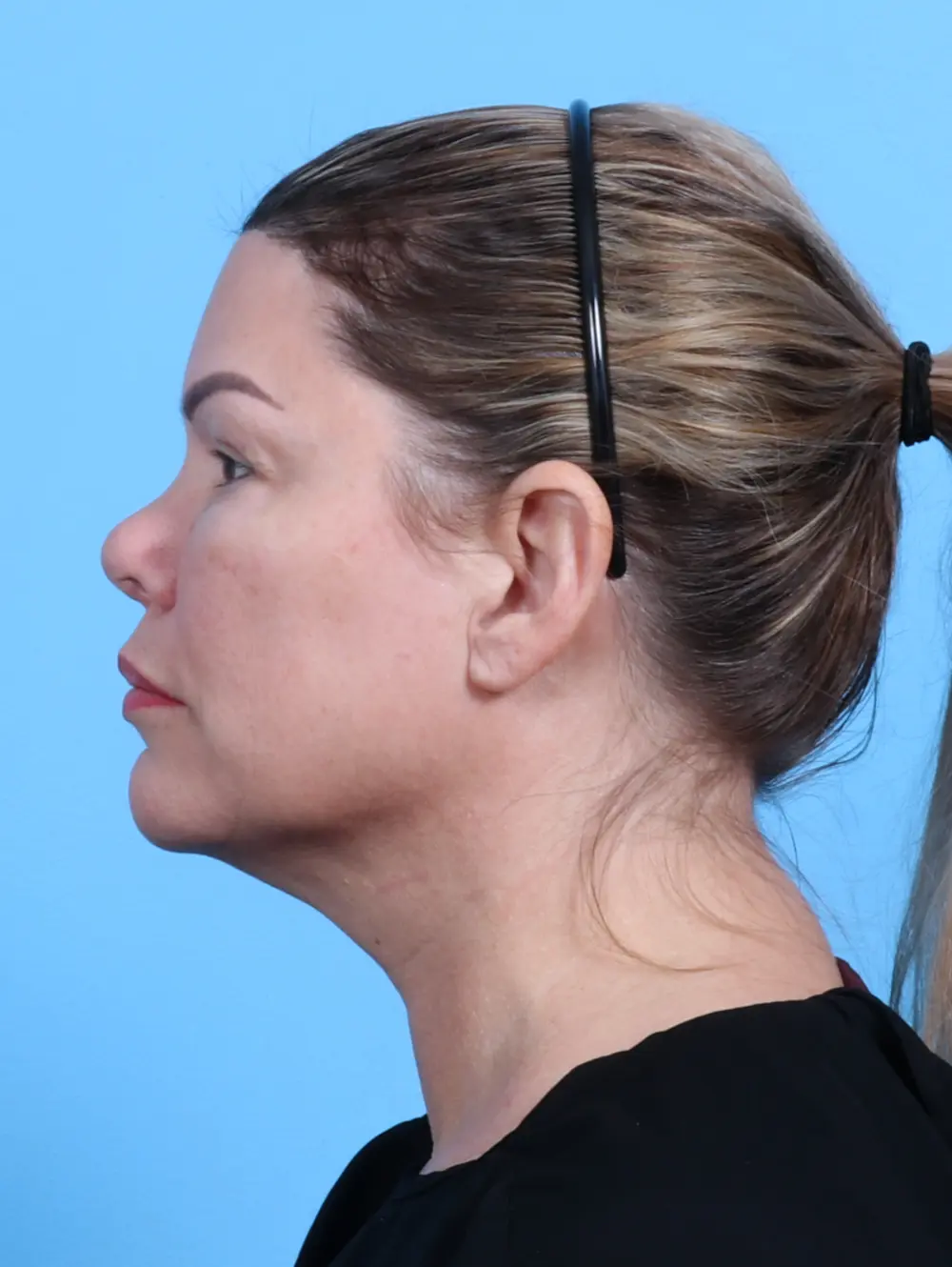 Facelift / Neck Lift Patient Photo - Case 28149 - before view-2