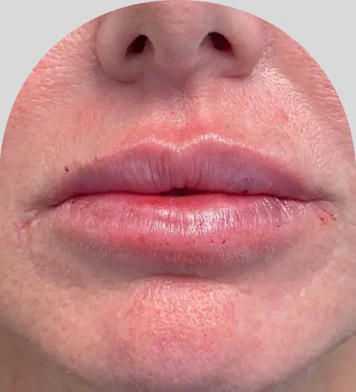Lip Fillers - Case 28182 - After