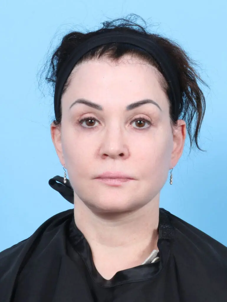 Brow Lift - Case 28079 - After