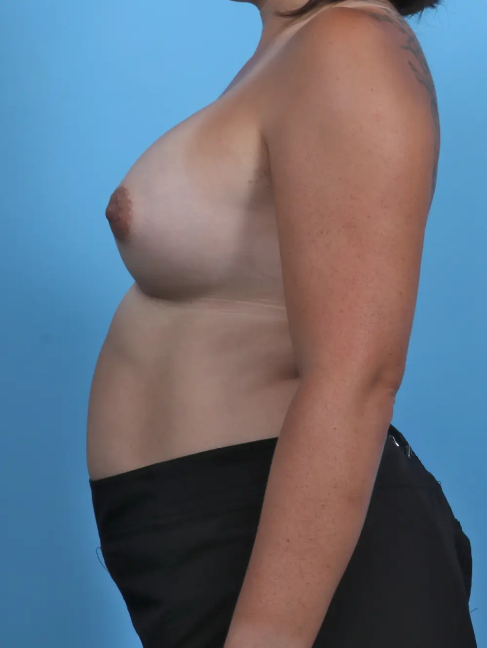 Breast Augmentation Patient Photo - Case 28303 - after view-2