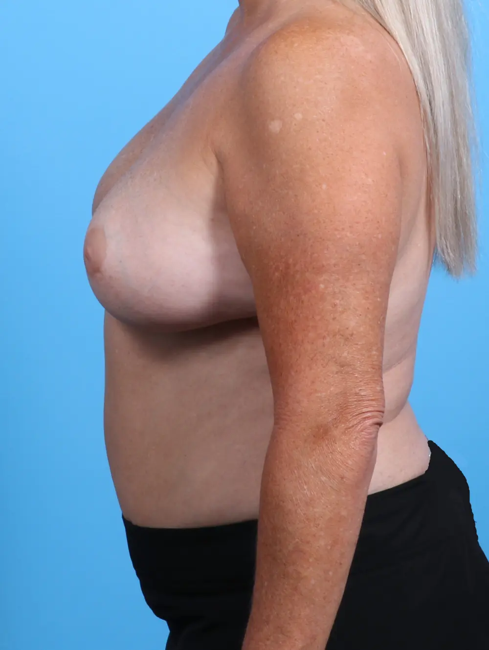 Breast Implant Revision Patient Photo - Case 28311 - before view-2