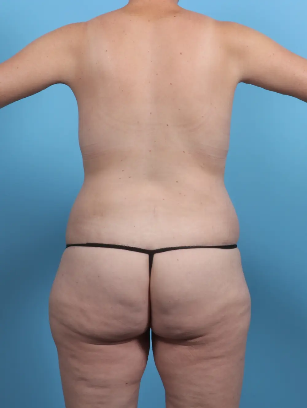 After Weight Loss Patient Photo - Case 28319 - after view-3