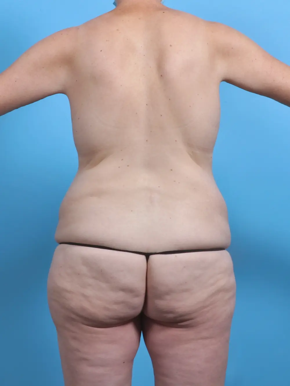 After Weight Loss Patient Photo - Case 28319 - before view-3