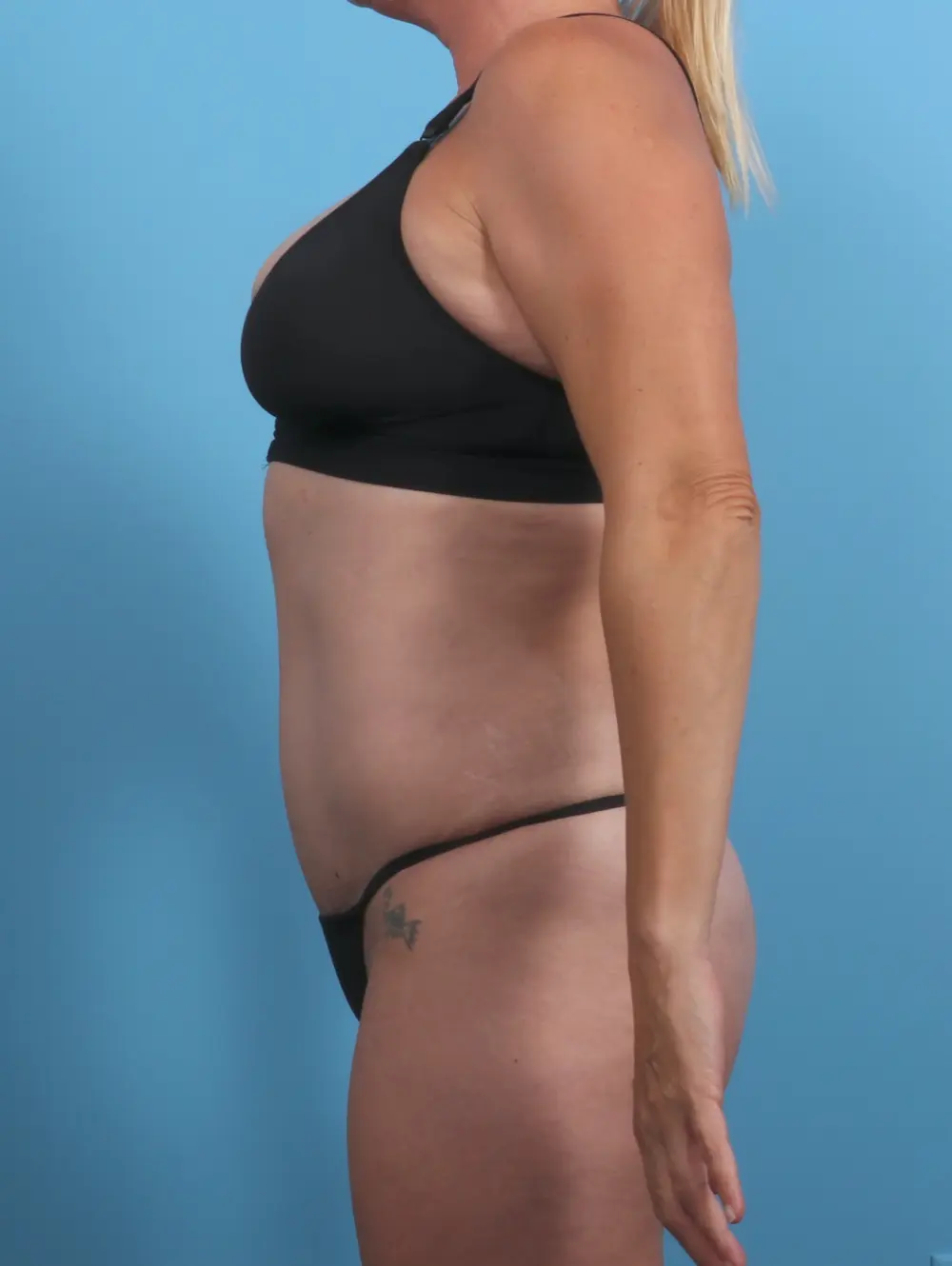 Tummy Tuck Patient Photo - Case 28329 - after view-2