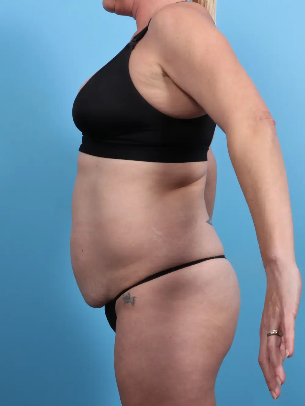 Tummy Tuck Patient Photo - Case 28329 - before view-2