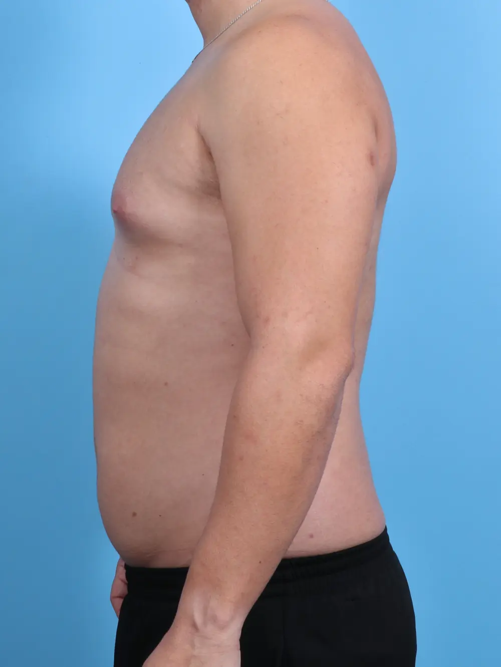 Gynecomastia Patient Photo - Case 28372 - before view-2