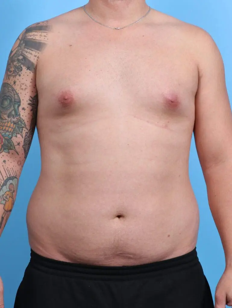 Gynecomastia - Case 28372 - Before