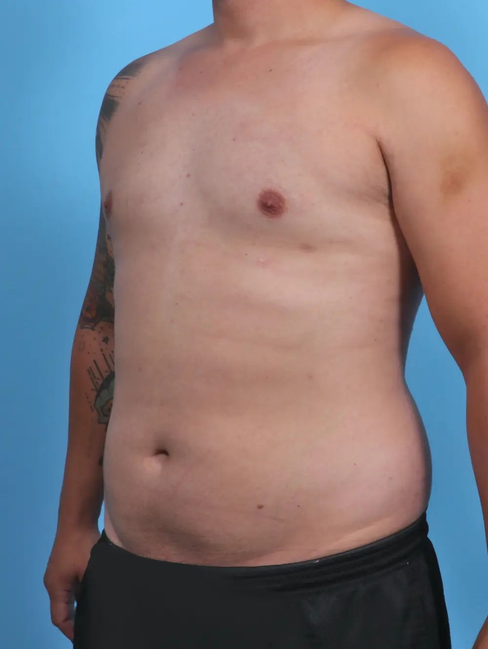Gynecomastia Patient Photo - Case 28372 - after view-1