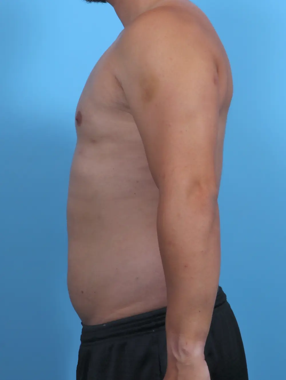 Gynecomastia Patient Photo - Case 28372 - after view-2
