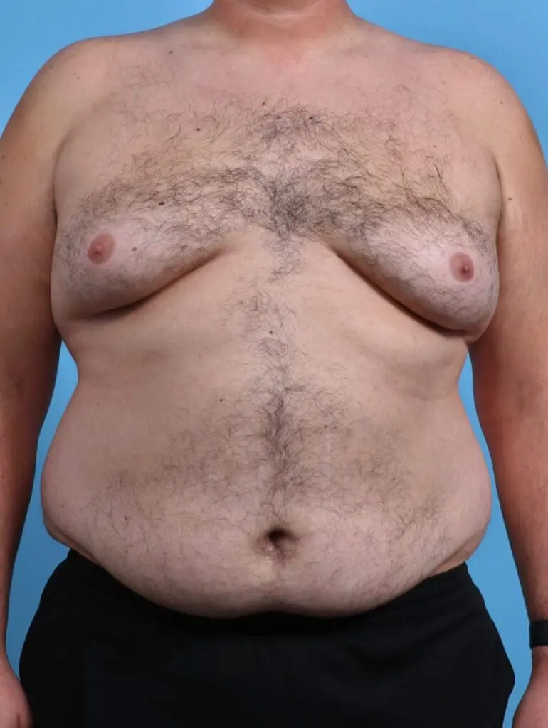 Gynecomastia - Case 28380 - Before