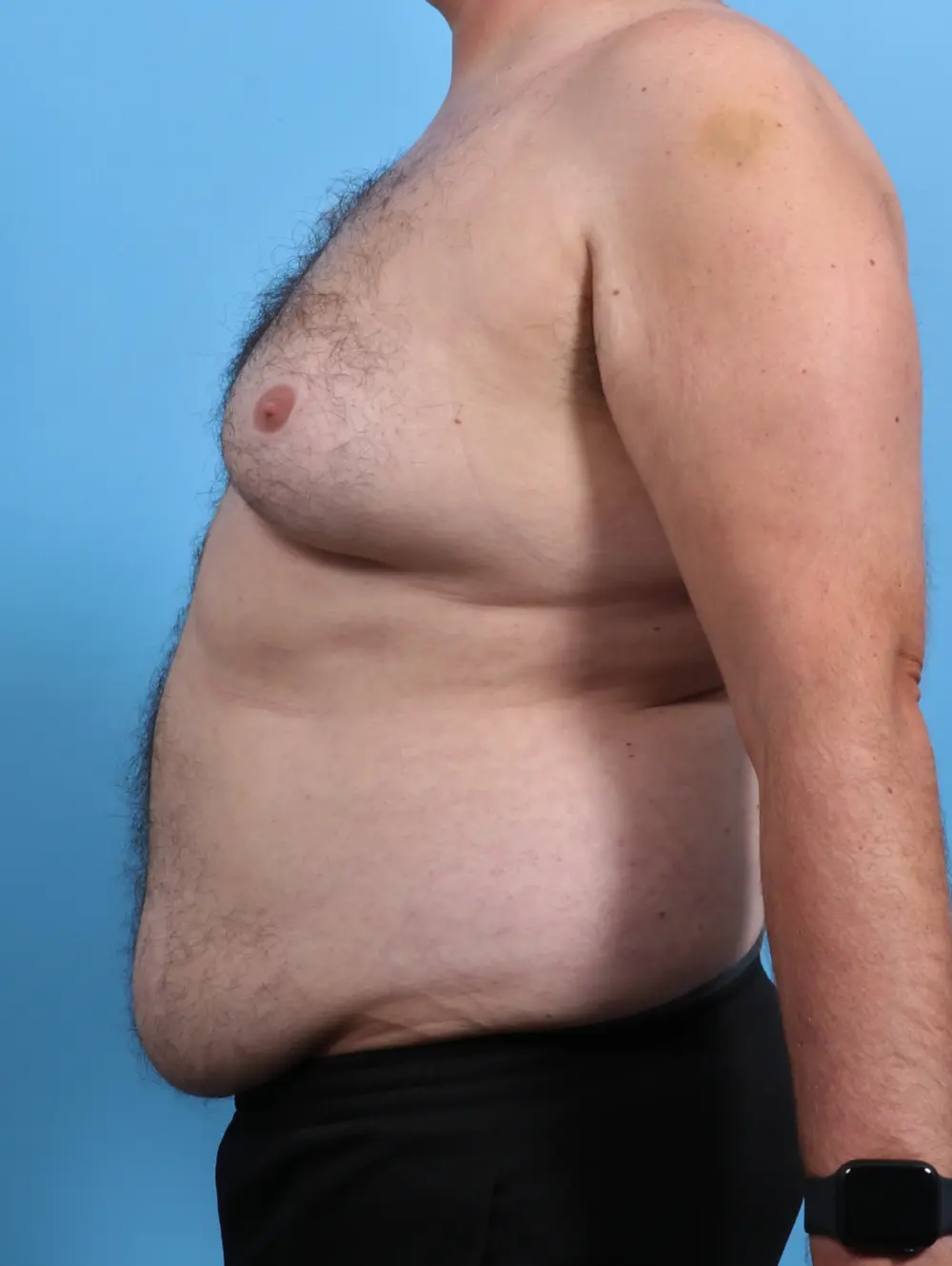 Gynecomastia Patient Photo - Case 28380 - before view-2
