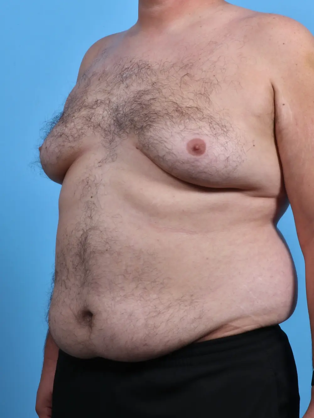 Gynecomastia Patient Photo - Case 28380 - before view-1