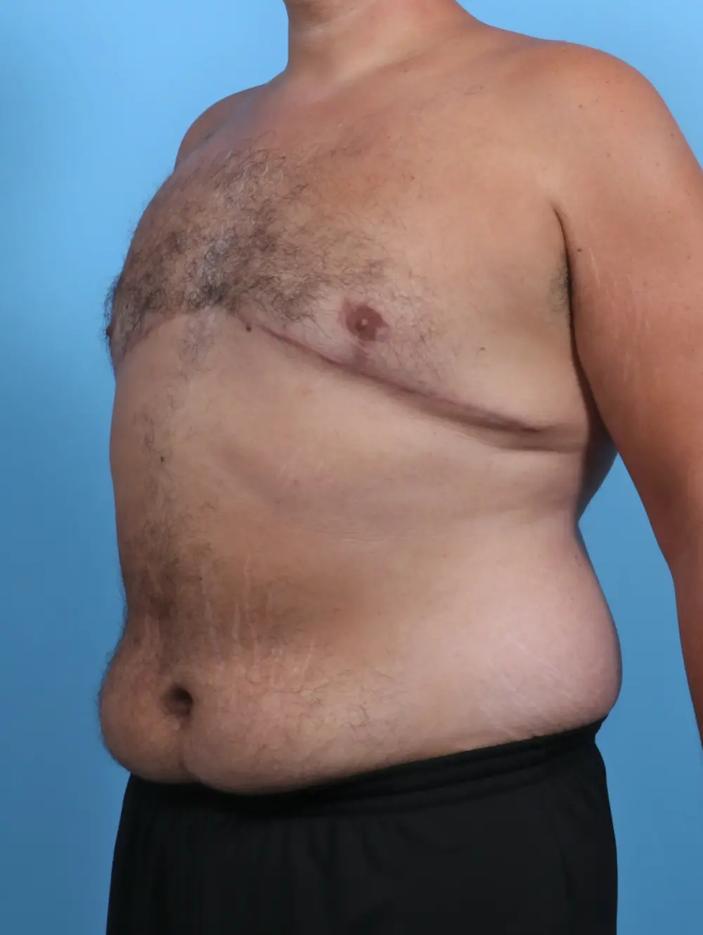 Gynecomastia Patient Photo - Case 28380 - after view-1