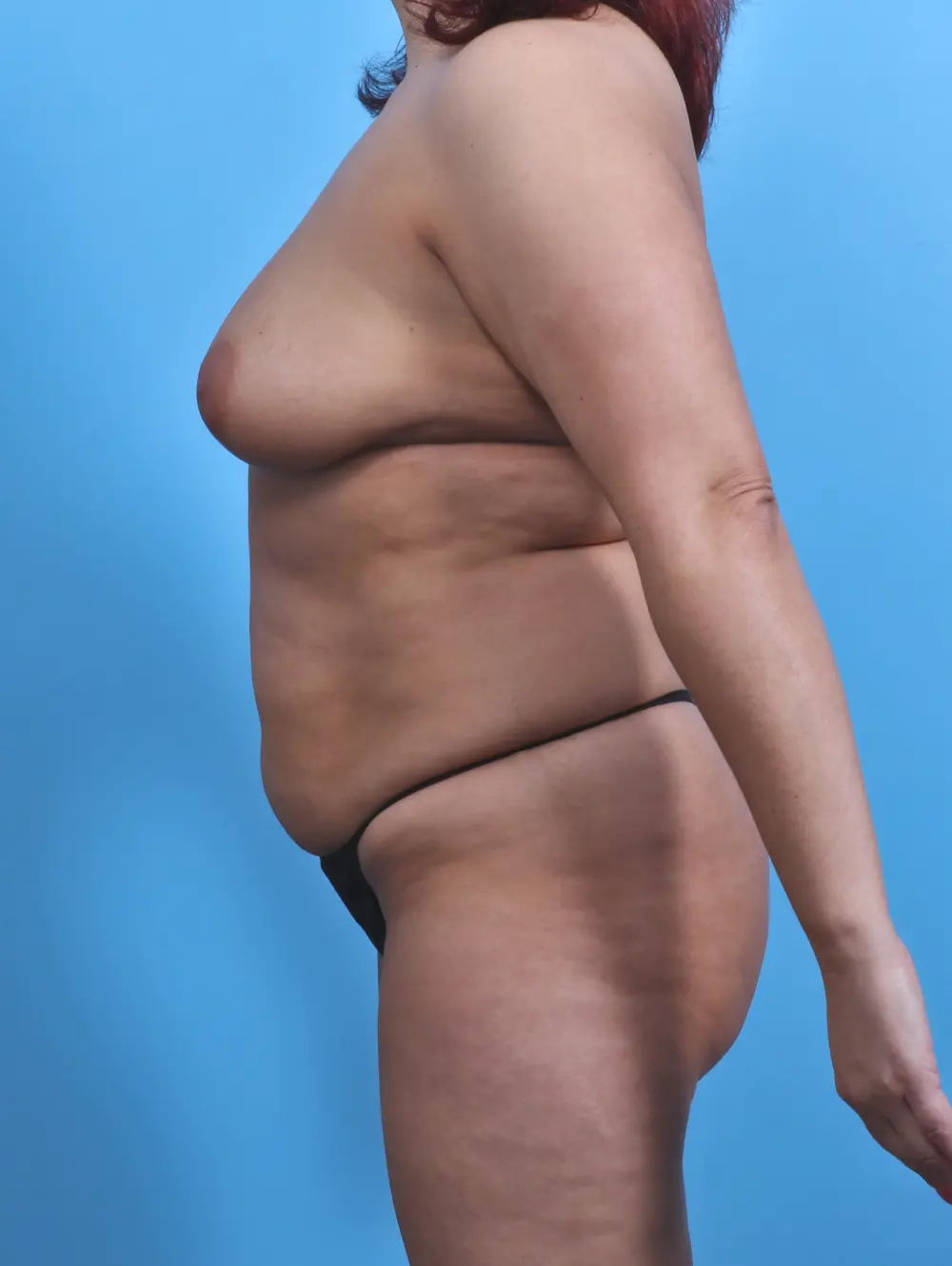 Breast Lift/Reduction with Implants Patient Photo - Case 28396 - before view-2