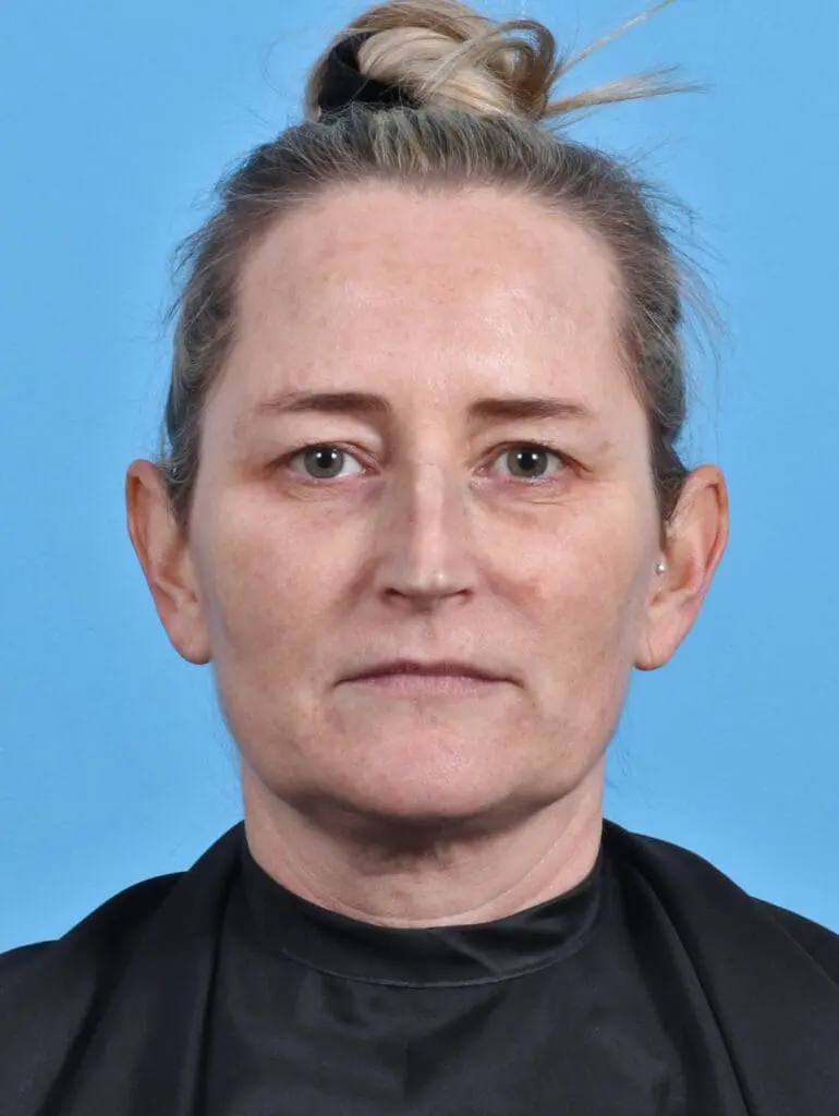 Eyelid Surgery - Case 28412 - Before