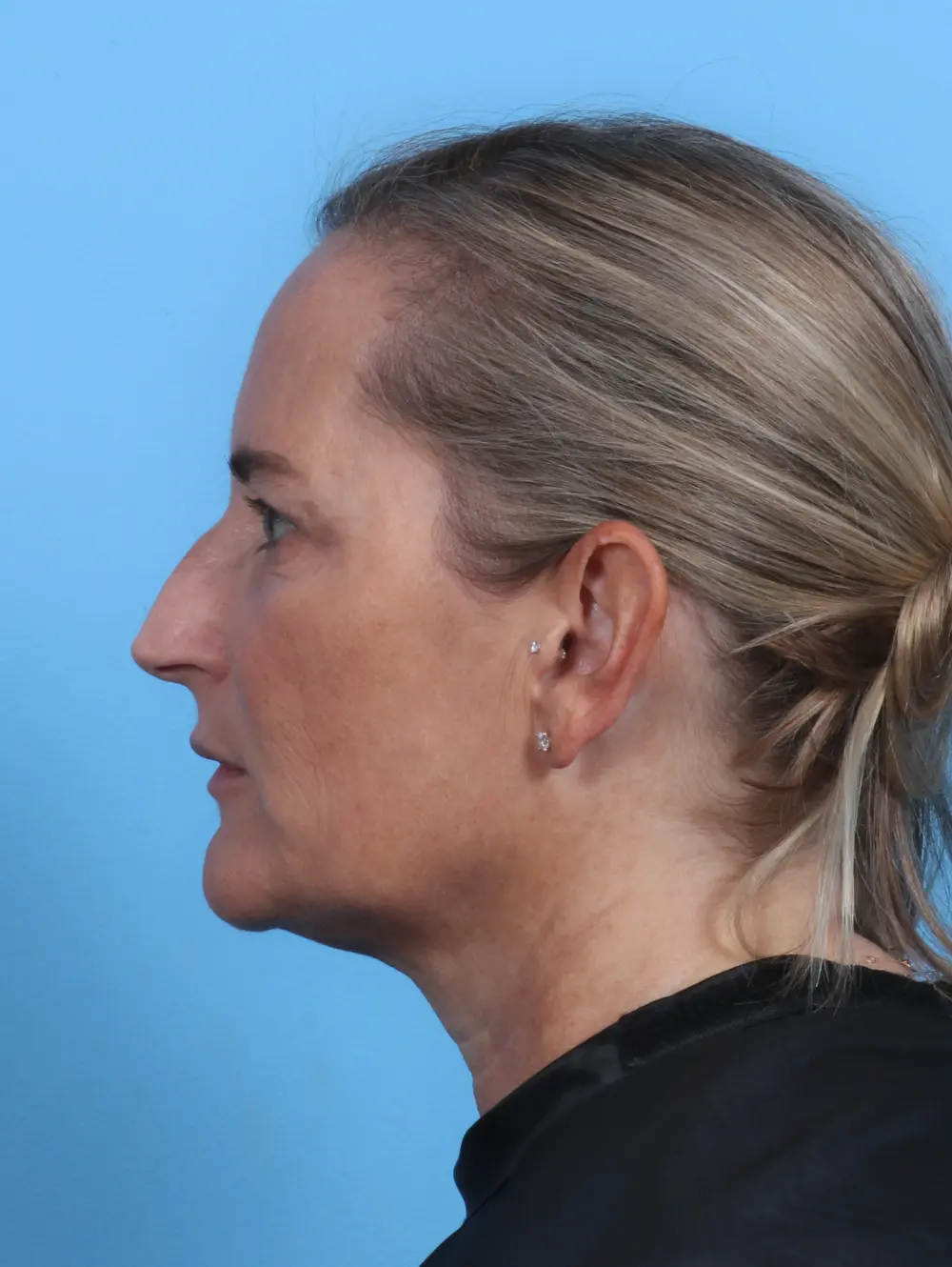 Eyelid Surgery Patient Photo - Case 28412 - after view-2