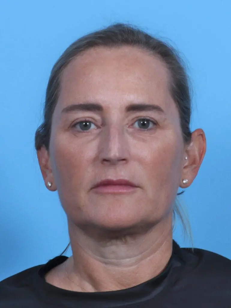 Eyelid Surgery - Case 28412 - After