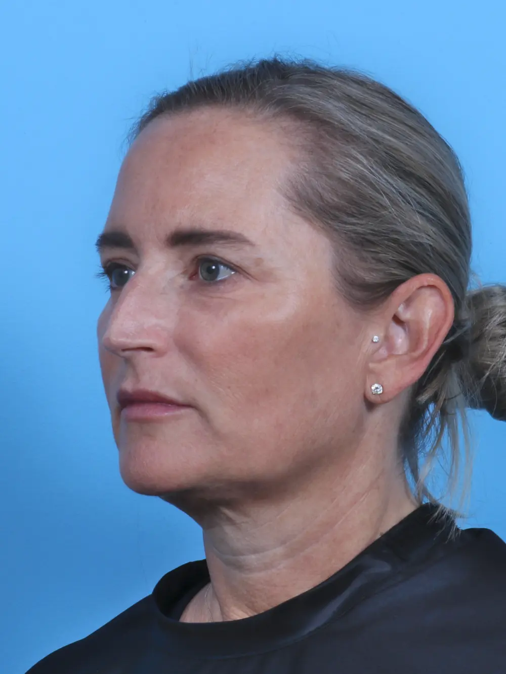 Eyelid Surgery Patient Photo - Case 28412 - after view-1