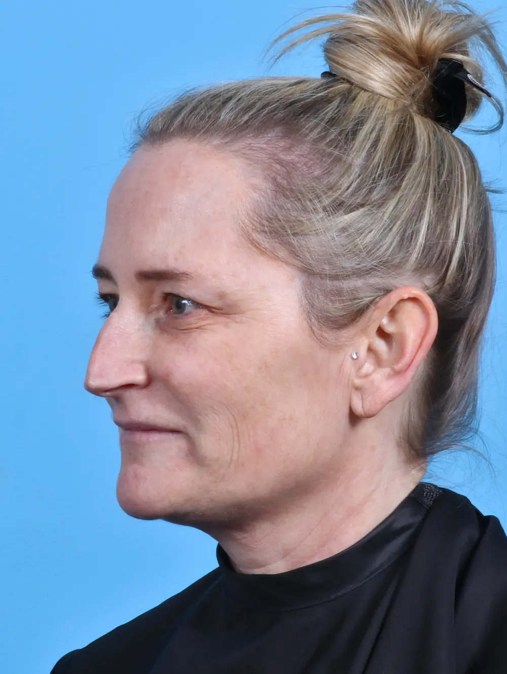 Eyelid Surgery Patient Photo - Case 28412 - before view-1