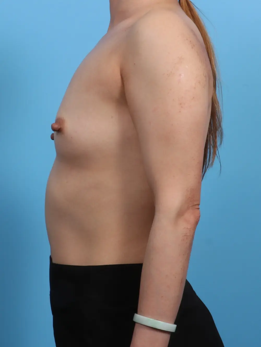 Breast Augmentation Patient Photo - Case 28420 - before view-2