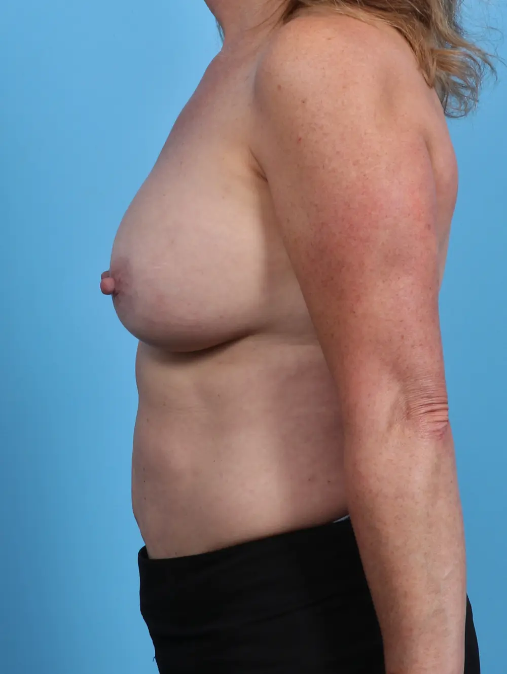 Breast Implant Removal Patient Photo - Case 28428 - before view-2