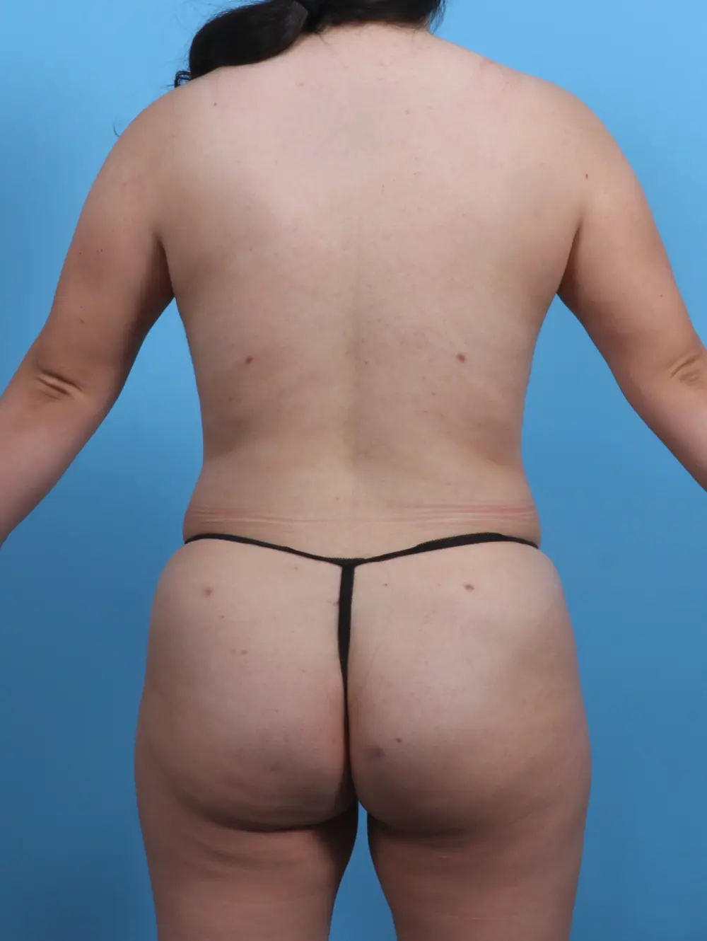Liposuction Patient Photo - Case 28452 - after view-3