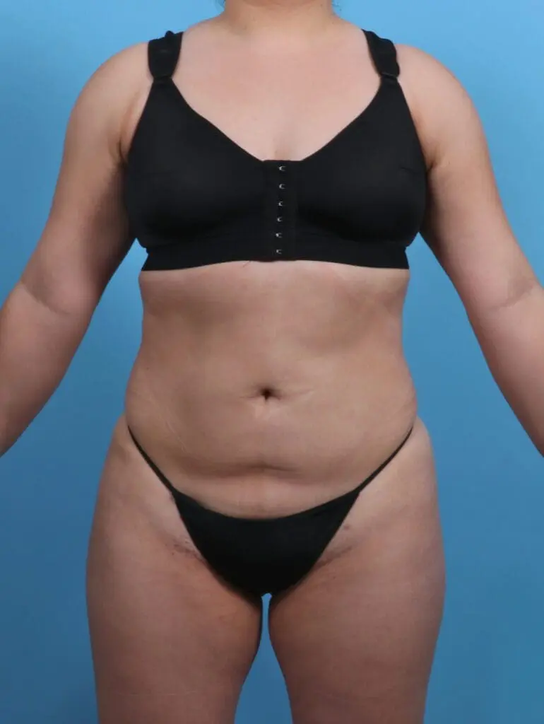 Liposuction - Case 28452 - After